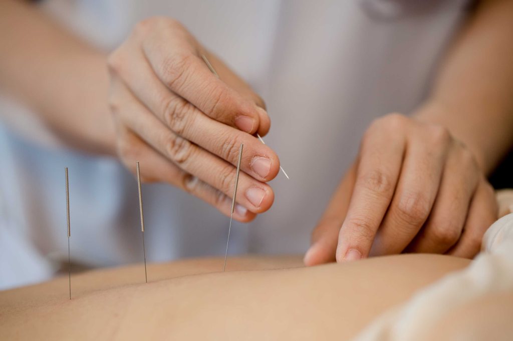 acupuntura en Zaragoza
