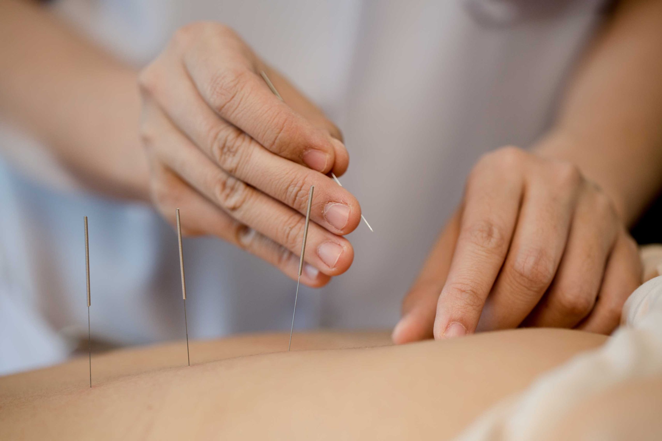 acupuntura en Zaragoza