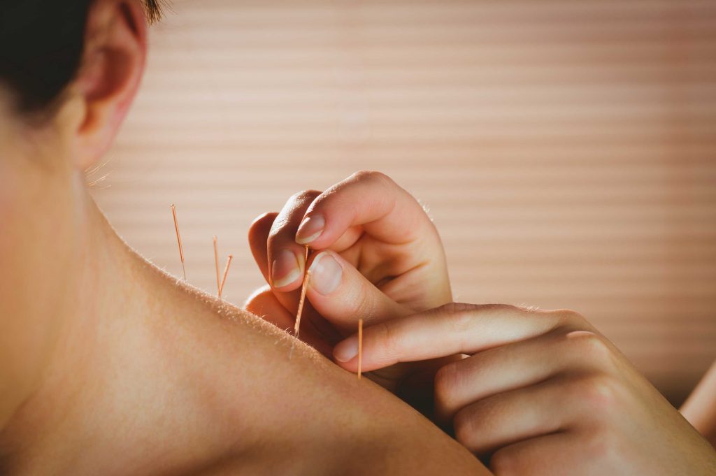 Acupuntura médica